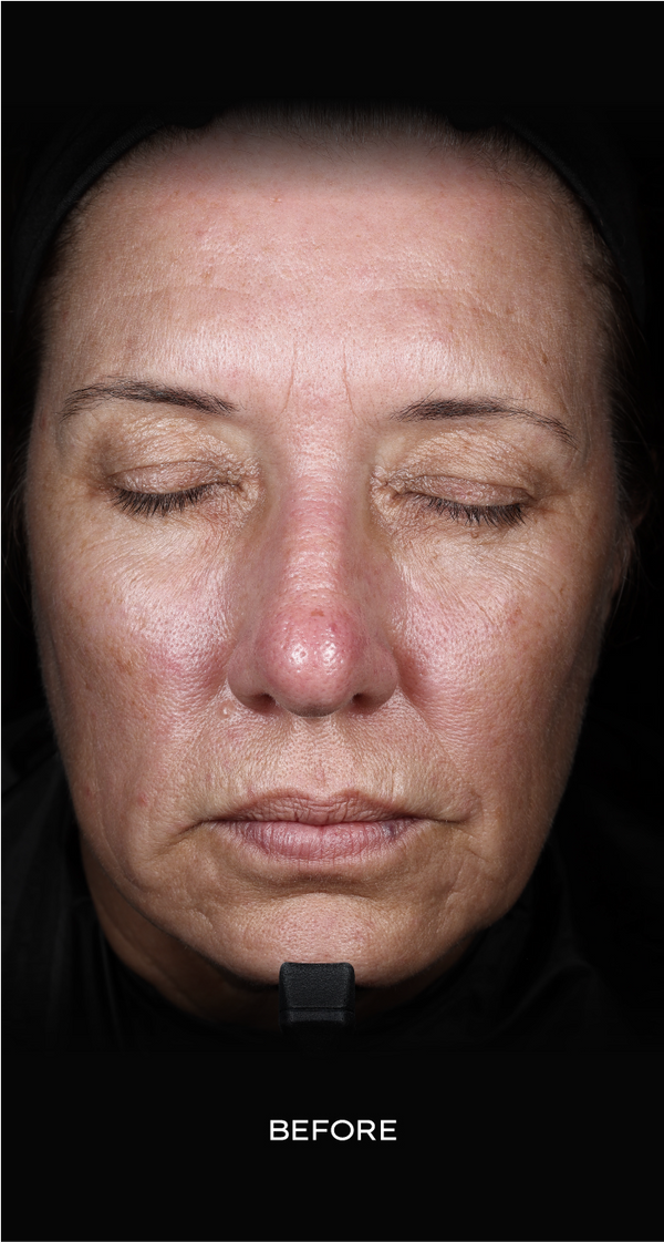 Before skincare result: 8 weeks