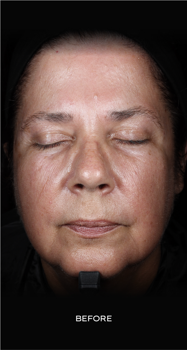 Before skincare result: 8 weeks