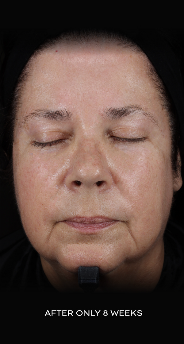 After skincare result: 8 weeks