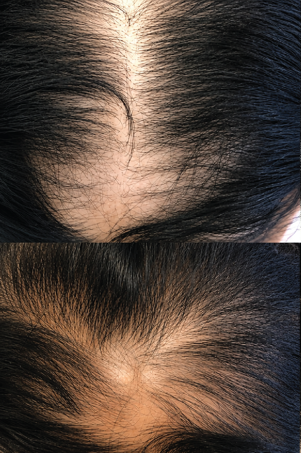 Before skincare result: 5 Months